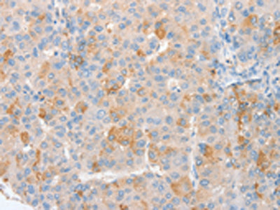 The image on the left is immunohistochemistry of paraffin-embedded Human liver cancer tissue using the antibody Tag Antibody) at dilution 1/10, on the right is treated with synthetic peptide. (Original magnification: ×200)Rabbit anti-Human MYC Polyclonal Antibody