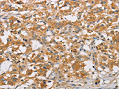The image on the left is immunohistochemistry of paraffin-embedded Human thyroid cancer tissue using ARHGEF7 Antibody(ARHGEF7 Antibody) at dilution 1/40, on the right is treated with fusion protein. (Original magnification: ×200)Rabbit anti-Human ARHGEF7 Polyclonal Antibody