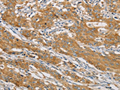 The image on the left is immunohistochemistry of paraffin-embedded Human gastic cancer tissue using the antibody Antibody) at dilution 1/40, on the right is treated with fusion protein. (Original magnification: ×200)