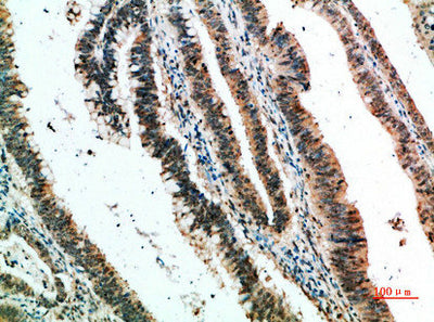 Immunohistochemical analysis of paraffin-embedded human-colon-cancer, antibody was diluted at 1:200Rabbit anti-Human CLEC4A Polyclonal Antibody