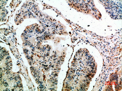 Immunohistochemical analysis of paraffin-embedded human-colon-cancer, antibody was diluted at 1:200Rabbit anti-Human CLEC4A Polyclonal Antibody