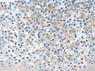 The image on the left is immunohistochemistry of paraffin-embedded Human tonsil tissue using NTF4 Antibody(NTF4 Antibody) at dilution 1/20, on the right is treated with fusion protein. (Original magnification: ×200)Rabbit anti-Human NTF4 Polyclonal Antibody