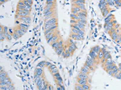 The image on the left is immunohistochemistry of paraffin-embedded Human colon cancer tissue using the antibody Antibody) at dilution 1/20, on the right is treated with fusion protein. (Original magnification: ×200)Rabbit anti-Human NTF4 Polyclonal Antibody