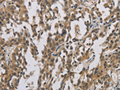 The image is immunohistochemistry of paraffin-embedded Human esophagus cancer tissue using CASP3 Antibody(CASP3 Antibody) at dilution 1/40. (Original magnification: X200)