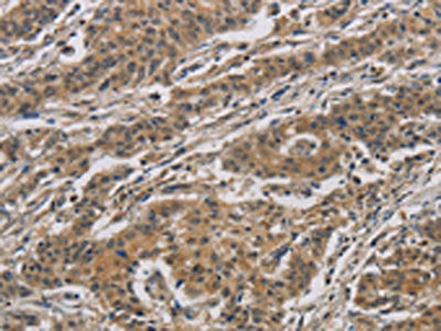 The image is immunohistochemistry of paraffin-embedded Human gastric cancer tissue using the antibody Antibody) at dilution 1/40. (Original magnification: X200)