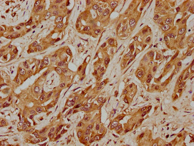 IHC image of the antibody diluted at 1:400 and staining in paraffin-embedded human liver cancer performed on a Leica BondTM system. After dewaxing and hydration, antigen retrieval was mediated by high pressure in a citrate buffer (pH 6.0). Section was blocked with 10% normal goat serum 30min at RT. Then primary antibody (1% BSA) was incubated at 4°C overnight. The primary is detected by a biotinylated secondary antibody and visualized using an HRP conjugated SP system.Rabbit anti-Human USP17L5 Polyclonal Antibody