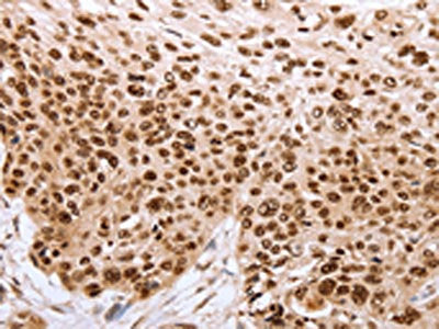 The image on the left is immunohistochemistry of paraffin-embedded Human esophagus cancer tissue using PARP1 Antibody(PARP1 Antibody) at dilution 1/40, on the right is treated with synthetic peptide. (Original magnification: ×200)Rabbit anti-Human PARP1 Polyclonal Antibody