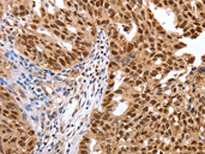 The image on the left is immunohistochemistry of paraffin-embedded Human ovarian cancer tissue using the antibody Antibody) at dilution 1/40, on the right is treated with synthetic peptide. (Original magnification: ×200)Rabbit anti-Human PARP1 Polyclonal Antibody