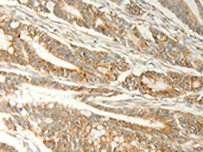 The image on the left is immunohistochemistry of paraffin-embedded Human colon cancer tissue using TRAF1 Antibody(TRAF1 Antibody) at dilution 1/20, on the right is treated with fusion protein. (Original magnification: ×200)Rabbit anti-Human TRAF1 Polyclonal Antibody