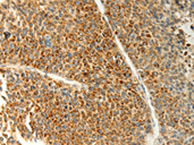 The image on the left is immunohistochemistry of paraffin-embedded Human liver cancer tissue using the antibody Antibody) at dilution 1/20, on the right is treated with fusion protein. (Original magnification: ×200)Rabbit anti-Human TRAF1 Polyclonal Antibody