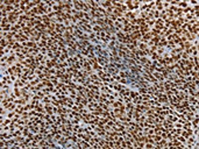 The image on the left is immunohistochemistry of paraffin-embedded Human ovarian cancer tissue using SSB Antibody(SSB Antibody) at dilution 1/25, on the right is treated with synthetic peptide. (Original magnification: ×200)Rabbit anti-Human SSB Polyclonal Antibody