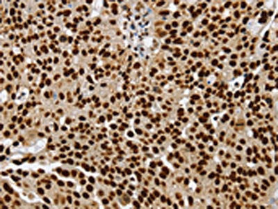 The image on the left is immunohistochemistry of paraffin-embedded Human breast cancer tissue using the antibody Antibody) at dilution 1/25, on the right is treated with synthetic peptide. (Original magnification: ×200)Rabbit anti-Human SSB Polyclonal Antibody