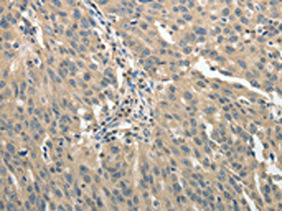 The image on the left is immunohistochemistry of paraffin-embedded Human ovarian cancer tissue using GSR Antibody(GSR Antibody) at dilution 1/50, on the right is treated with fusion protein. (Original magnification: ×200)