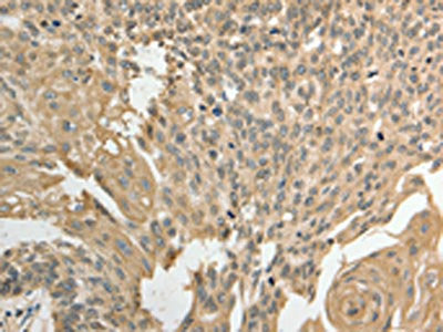 The image on the left is immunohistochemistry of paraffin-embedded Human cervical cancer tissue using the antibody Antibody) at dilution 1/50, on the right is treated with fusion protein. (Original magnification: ×200)
