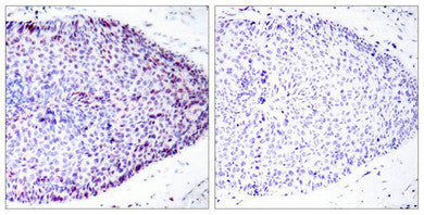 Immunohistochemical analysis of paraffin-embedded human breast carcinoma tissue using ATF2(Ab-62 or 44) Antibody(left) or the same antibody preincubated with blocking peptide(right).Rabbit anti-Human ATF2 Polyclonal Antibody