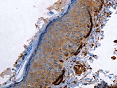 The image on the left is immunohistochemistry of paraffin-embedded Human skin tissue using CALD1 Antibody(CALD1 Antibody) at dilution 1/40, on the right is treated with fusion protein. (Original magnification: ×200)