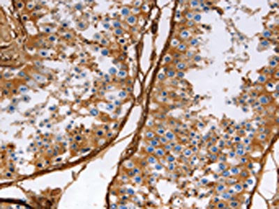 The image on the left is immunohistochemistry of paraffin-embedded Human testis tissue using the antibody Antibody) at dilution 1/40, on the right is treated with fusion protein. (Original magnification: ×200)