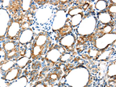 The image on the left is immunohistochemistry of paraffin-embedded Human thyroid cancer tissue using GPD2 Antibody(GPD2 Antibody) at dilution 1/20, on the right is treated with synthetic peptide. (Original magnification: ×200)Rabbit anti-Human GPD2 Polyclonal Antibody