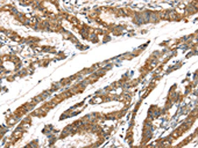 The image on the left is immunohistochemistry of paraffin-embedded Human esophagus cancer tissue using the antibody Antibody) at dilution 1/20, on the right is treated with synthetic peptide. (Original magnification: ×200)Rabbit anti-Human GPD2 Polyclonal Antibody