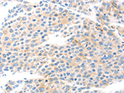 The image on the left is immunohistochemistry of paraffin-embedded Human liver cancer tissue using COL2A1 Antibody(COL2A1 Antibody) at dilution 1/15, on the right is treated with fusion protein. (Original magnification: X200)Rabbit anti-Human COL2A1 Polyclonal Antibody