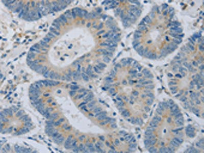 The image on the left is immunohistochemistry of paraffin-embedded Human colon cancer tissue using the antibody Antibody) at dilution 1/15, on the right is treated with fusion protein. (Original magnification: X200)Rabbit anti-Human COL2A1 Polyclonal Antibody
