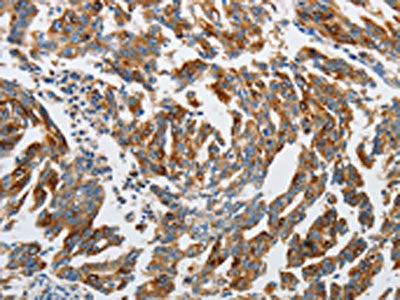 The image on the left is immunohistochemistry of paraffin-embedded Human gastric cancer tissue using ATG4A Antibody(ATG4A Antibody) at dilution 1/45, on the right is treated with synthetic peptide. (Original magnification: ×200)