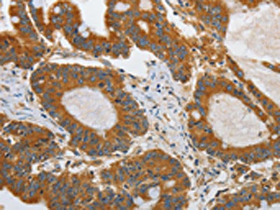 The image on the left is immunohistochemistry of paraffin-embedded Human colon cancer tissue using the antibody Antibody) at dilution 1/45, on the right is treated with synthetic peptide. (Original magnification: ×200)