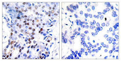 Immunohistochemical analysis of paraffin-embedded human breast carcinoma tissue using c-Jun(Ab-91) Antibody(left) or the same antibody preincubated with blocking peptide(right).