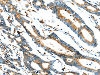 The image on the left is immunohistochemistry of paraffin-embedded Human colorectal cancer tissue using ERP44 Antibody(ERP44 Antibody) at dilution 1/20, on the right is treated with synthetic peptide. (Original magnification: ×200)Rabbit anti-Human ERP44 Polyclonal Antibody