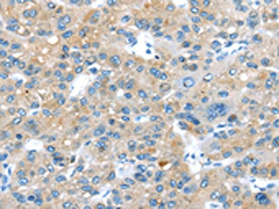 The image on the left is immunohistochemistry of paraffin-embedded Human liver cancer tissue using the antibody Antibody) at dilution 1/20, on the right is treated with synthetic peptide. (Original magnification: ×200)Rabbit anti-Human ERP44 Polyclonal Antibody