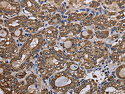 The image on the left is immunohistochemistry of paraffin-embedded Human thyroid cancer tissue using KRT31 Antibody(KRT31 Antibody) at dilution 1/20, on the right is treated with fusion protein. (Original magnification: ×200)