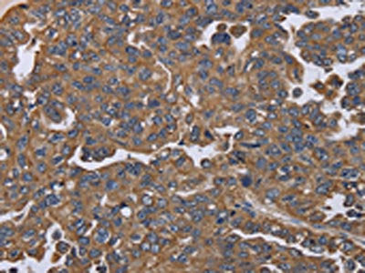 The image on the left is immunohistochemistry of paraffin-embedded Human ovarian cancer tissue using the antibody Antibody) at dilution 1/20, on the right is treated with fusion protein. (Original magnification: ×200)