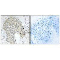 Immunohistochemistry analysis of paraffin-embedded human breast carcinoma tissue using PPP1R2 (Ab-120/121) antibody.