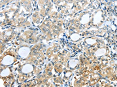 The image on the left is immunohistochemistry of paraffin-embedded Human thyroid cancer tissue using PAK3 Antibody(PAK3 Antibody) at dilution 1/25, on the right is treated with synthetic peptide. (Original magnification: ×200)Rabbit anti-Human PAK3 Polyclonal Antibody