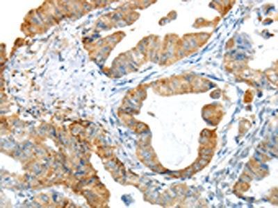 The image on the left is immunohistochemistry of paraffin-embedded Human esophagus cancer tissue using the antibody Antibody) at dilution 1/25, on the right is treated with synthetic peptide. (Original magnification: ×200)Rabbit anti-Human PAK3 Polyclonal Antibody