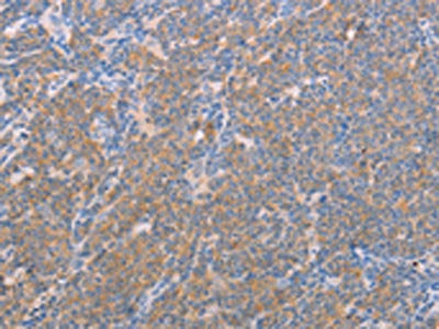 The image on the left is immunohistochemistry of paraffin-embedded Human lymphoma tissue using the antibody Antibody) at dilution 1/25, on the right is treated with fusion protein. (Original magnification: ×200)Rabbit anti-Human NFKBIE Polyclonal Antibody