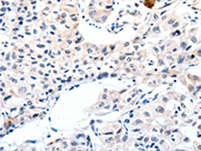 The image on the left is immunohistochemistry of paraffin-embedded Human lung cancer tissue using IGFBP7 Antibody(IGFBP7 Antibody) at dilution 1/25, on the right is treated with synthetic peptide. (Original magnification: ×200)Rabbit anti-Human IGFBP7 Polyclonal Antibody
