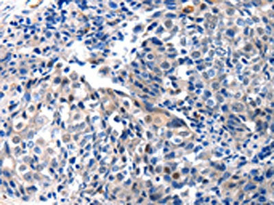 The image on the left is immunohistochemistry of paraffin-embedded Human breast cancer tissue using the antibody Antibody) at dilution 1/25, on the right is treated with synthetic peptide. (Original magnification: ×200)