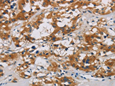 The image is immunohistochemistry of paraffin-embedded Human thyroid cancer tissue using CNDP1 Antibody(CNDP1 Antibody) at dilution 1/30. (Original magnification: ×200)Rabbit anti-Human CNDP1 Polyclonal Antibody