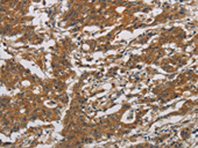 The image is immunohistochemistry of paraffin-embedded Human gastic cancer tissue using the antibody Antibody) at dilution 1/30. (Original magnification: ×200)Rabbit anti-Human CNDP1 Polyclonal Antibody