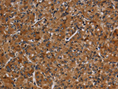The image on the left is immunohistochemistry of paraffin-embedded Human prostate cancer tissue using the antibody Antibody) at dilution 1/40, on the right is treated with synthetic peptide. (Original magnification: ×200)Rabbit anti-Human CYP1A2 Polyclonal Antibody