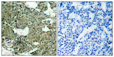 Immunohistochemical analysis of paraffin-embedded human breast carcinoma tissue using MEK1(Phospho-Ser221) Antibody(left) or the same antibody preincubated with blocking peptide(right).