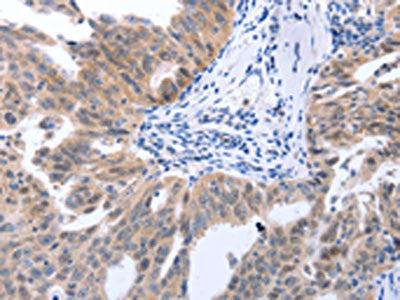 The image on the left is immunohistochemistry of paraffin-embedded Human ovarian cancer tissue using MAP2K1 Antibody(MAP2K1 Antibody) at dilution 1/25, on the right is treated with synthetic peptide. (Original magnification: ×200)