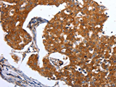 The image on the left is immunohistochemistry of paraffin-embedded Human breast cancer tissue using the antibody Antibody) at dilution 1/25, on the right is treated with synthetic peptide. (Original magnification: ×200)