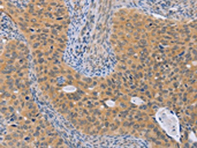 The image on the left is immunohistochemistry of paraffin-embedded Human cervical cancer tissue using BRS3 Antibody(BRS3 Antibody) at dilution 1/50, on the right is treated with synthetic peptide. (Original magnification: ×200)