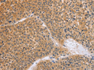 The image on the left is immunohistochemistry of paraffin-embedded Human liver cancer tissue using the antibody Antibody) at dilution 1/50, on the right is treated with synthetic peptide. (Original magnification: ×200)