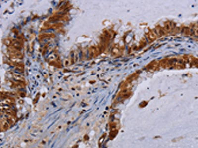 The image on the left is immunohistochemistry of paraffin-embedded Human esophagus cancer tissue using the antibody Antibody) at dilution 1/60, on the right is treated with fusion protein. (Original magnification: ×200)