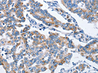 The image on the left is immunohistochemistry of paraffin-embedded Human breast cancer tissue using CHDH Antibody(CHDH Antibody) at dilution 1/25, on the right is treated with fusion protein. (Original magnification: ×200)Rabbit anti-Human CHDH Polyclonal Antibody