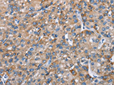 The image on the left is immunohistochemistry of paraffin-embedded Human liver cancer tissue using the antibody Antibody) at dilution 1/25, on the right is treated with fusion protein. (Original magnification: ×200)Rabbit anti-Human CHDH Polyclonal Antibody