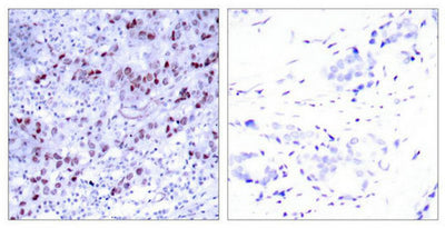 Immunohistochemical analysis of paraffin-embedded human breast carcinoma tissue using GATA1(Ab-142) Antibody(left) or the same antibody preincubated with blocking peptide(right).Rabbit anti-Human GATA1 Polyclonal Antibody